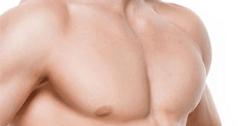 Gynecomasty
