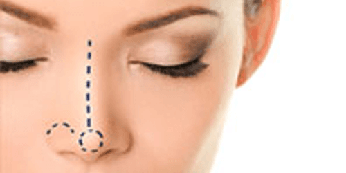 Rhinoplasty