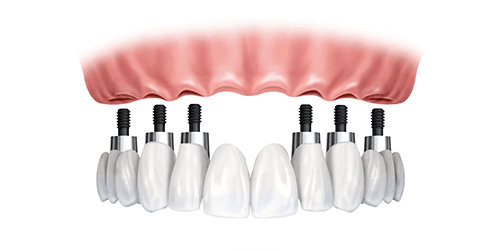 Reconstruction Totale