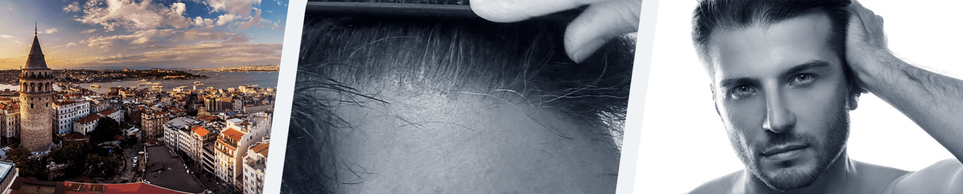 FUE Sapphire Greffe de cheveux Turquie : forfait implant capillaire banner