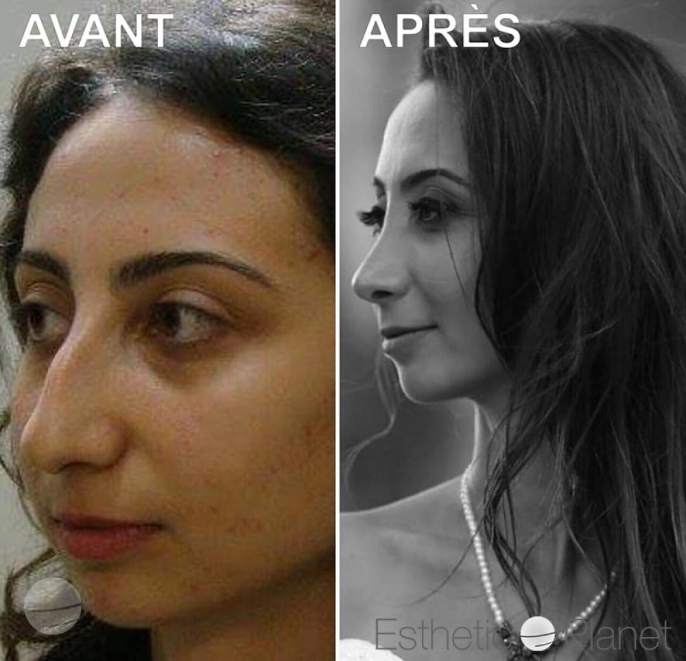 Résultat avant / après